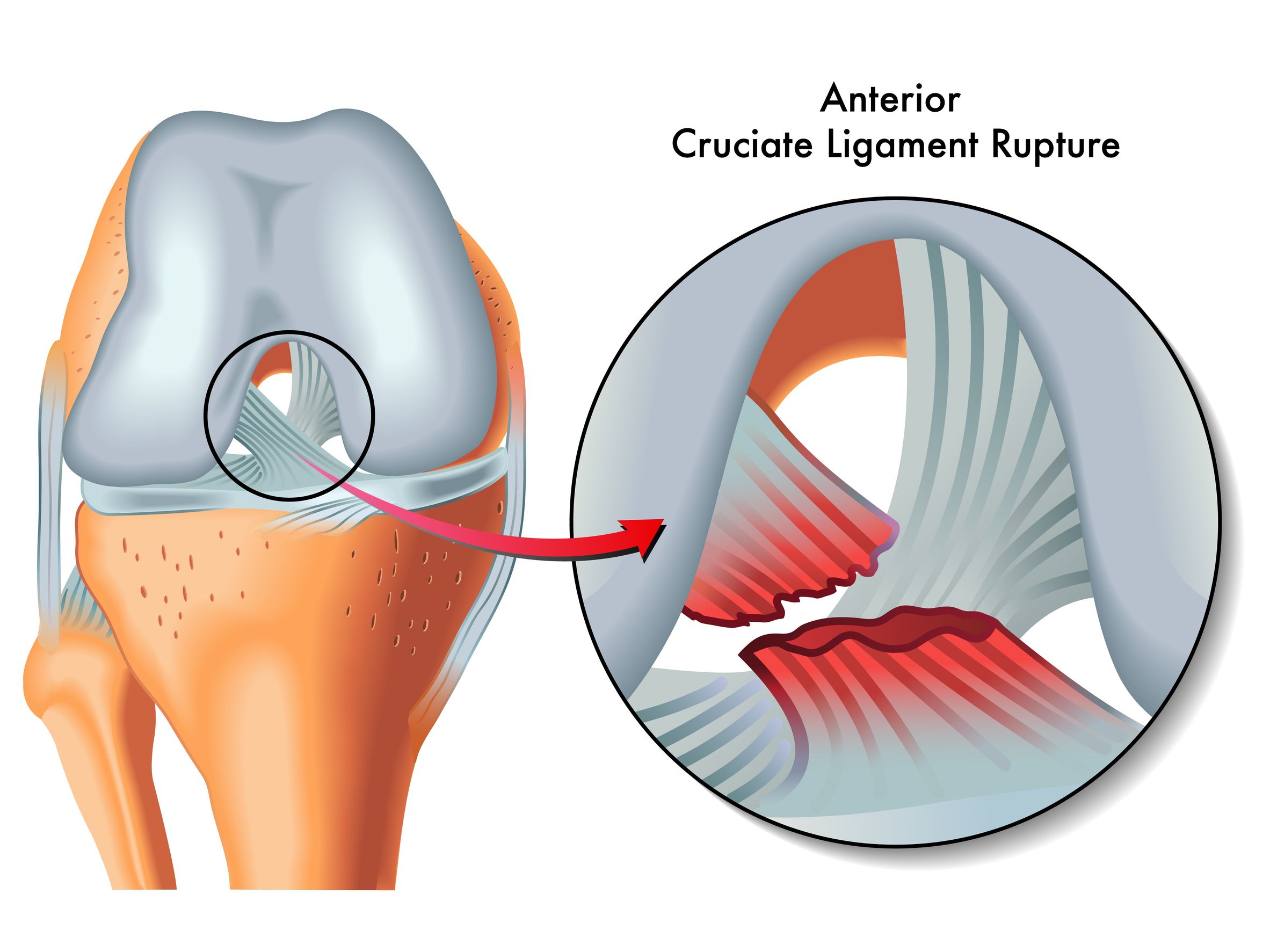 The Anterior Cruciate Ligament Acl Physio Fitness