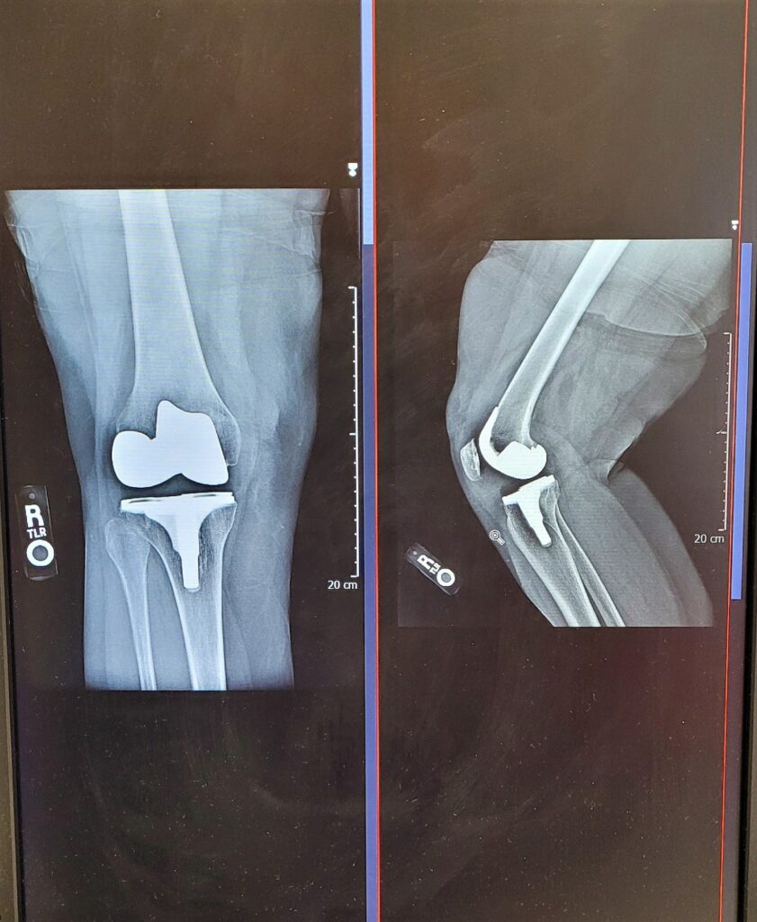 Xray! Orthopedic Surgery! Full Knee Joint Replacement! Healthcare and Medicine!
