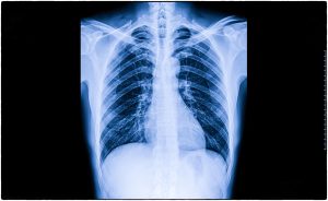 X-Ray film scan of human.